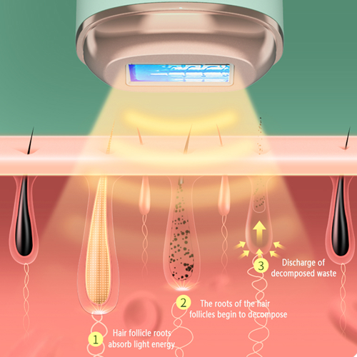 T63 IPL hair removal