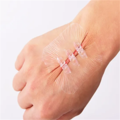 Noninvasive Zip Stitch Wound Closure Device Without Suture for Wound Care Wound Skin Closure