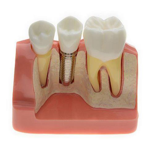 Dental Removable Implant Study Analysis Crown Bridge Demonstration Teeth Model