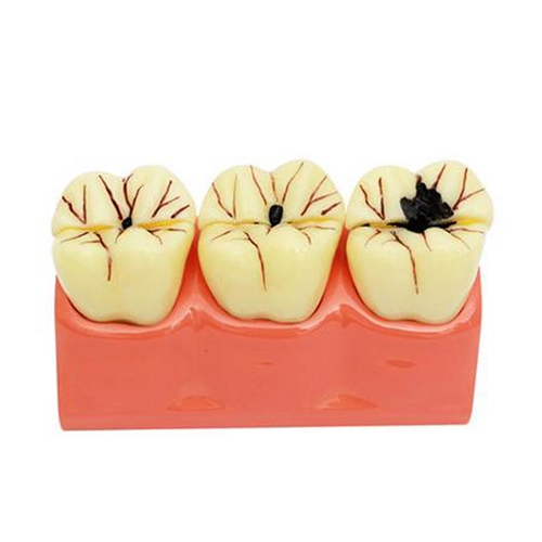 Assorted Dental Teaching Model Evolution Of Teeth Caries Cavity Tooth