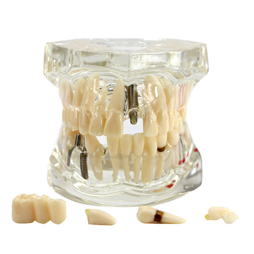 Dental Implant Disease Study Teachin Teeth Model With Restoration &amp; Bridge Tooth