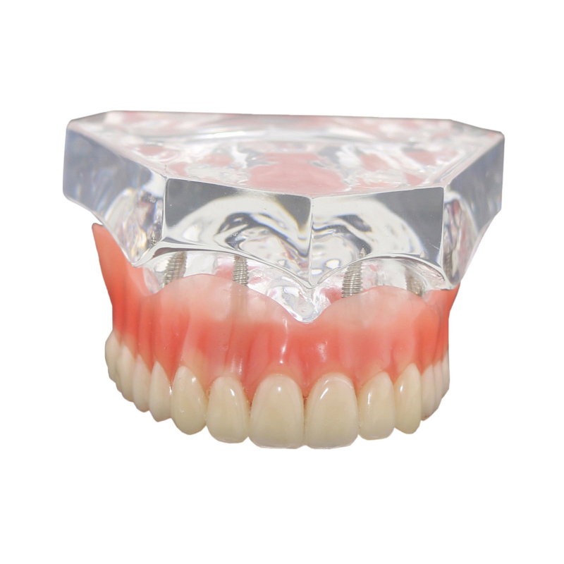 Dental Upper/Lower Teeth Model Overdenture Superior 4 Implants Demo Model