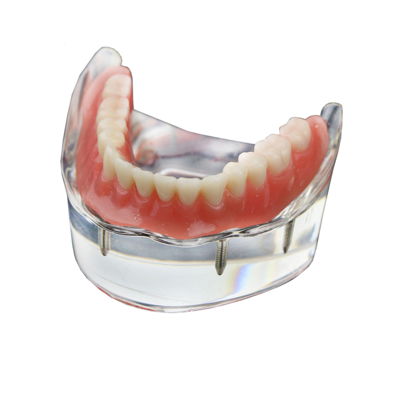 Dental Upper/Lower Teeth Model Overdenture Superior 4 Implants Demo Model