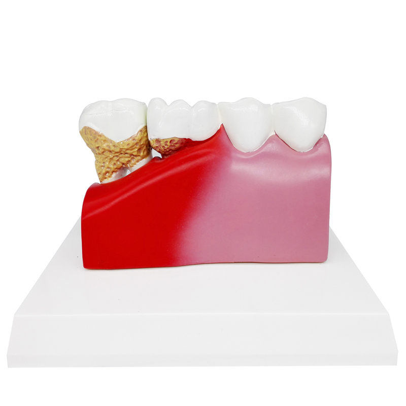 Dental Detachable Caries Demonstration Anatomical Teeth Common Pathologies Model