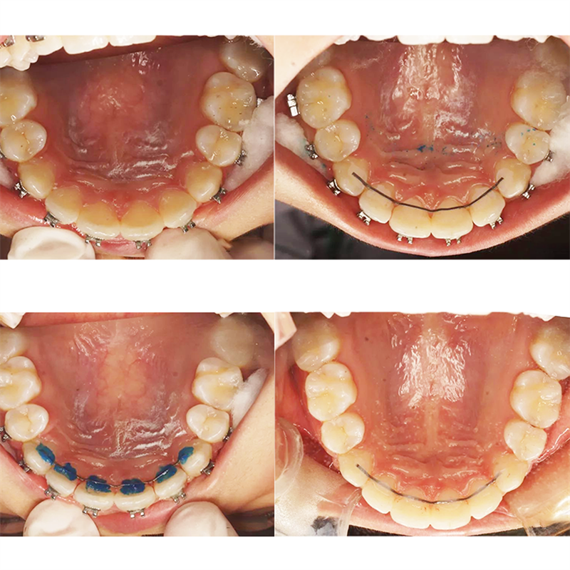 Dental Orthodontic Flat Strand Lingual Retainer Wire .010&quot;x.028&quot; .010&quot;x.032&quot;