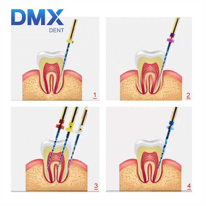 DMXDENT Dental Protaper PT-Blue Heat Activated Niti Endodontic Root Rotary Canal Files LED ENDO Motor Cordless 16:1 Contra Angle Handpiece