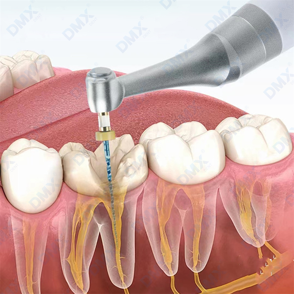 Dental Wireless Endo Motor 16:1 Contra Angle Endodontic Root Canal Treatment