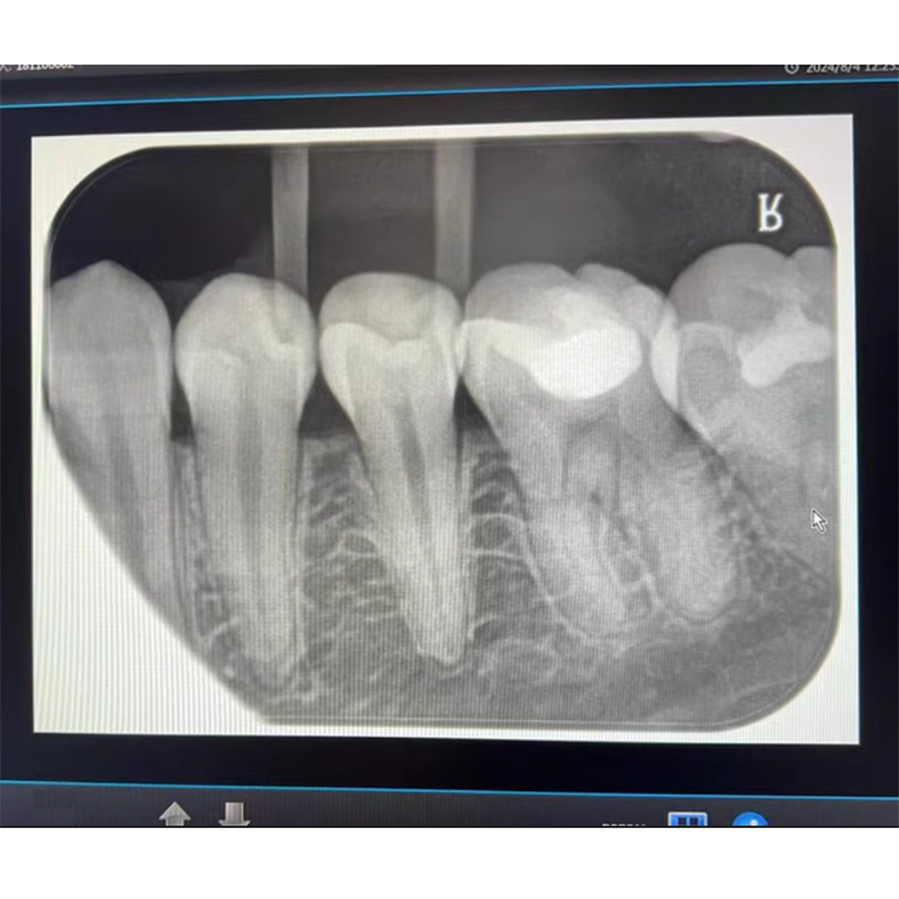1Pcs Dental X-ray Phosphor Plates Digital Imaging Storage Plates Size #2 31X41mm