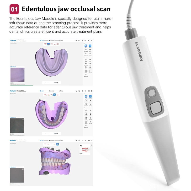 Runyes 3DS V5 Dental Intra-oral Scanner 3D Real-time Display Software ...