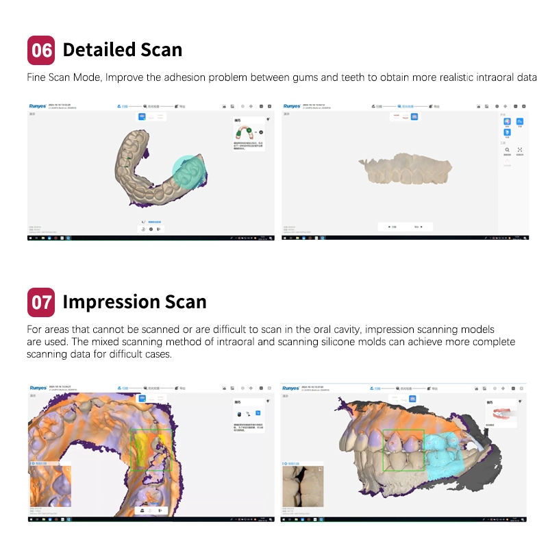 Runyes 3DS V5 Dental Intra-oral Scanner 3D Real-time Display Software ...