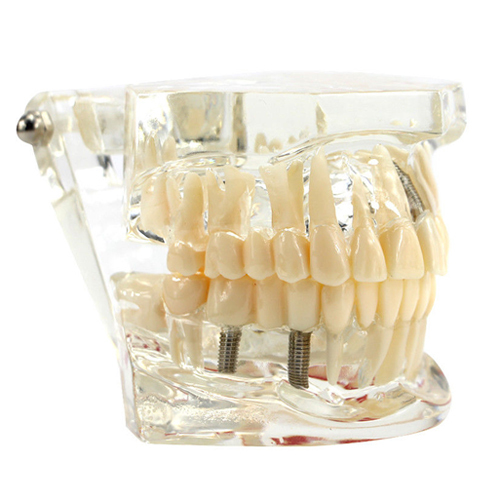 Dental Implant Disease Study Teachin Teeth Model With Restoration & Bridge Tooth