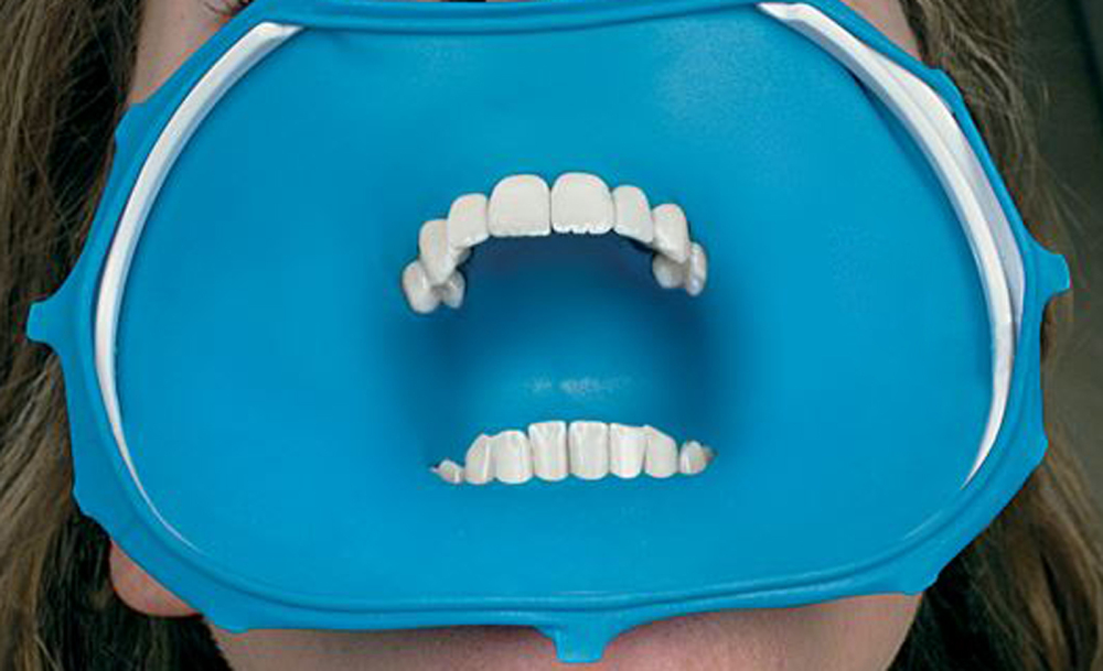Dental Endo 3D Frame X-Ray Film Plastic Rubber Dam Sheets Holder