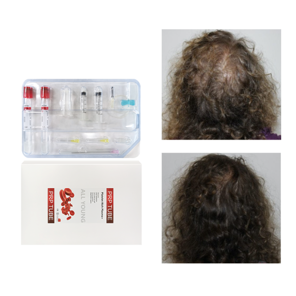 Disposable Prp Tubes Kit with Acd Gel Sale Excellent