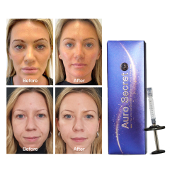 long lasting safe anti-wrinkle injections Hyaluronic acid dermal filler