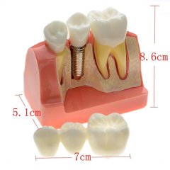 Dental Removable Implant Study Analysis Crown Bridge Demonstration Teeth Model