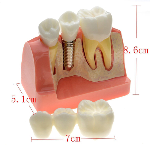 ****Dental Removable Implant Study Analysis Crown Bridge Demonstration Teeth Model