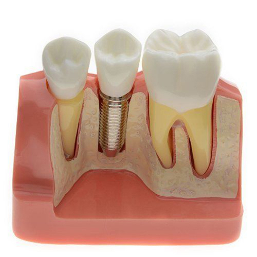 ****Dental Removable Implant Study Analysis Crown Bridge Demonstration Teeth Model