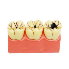 Assorted Dental Teaching Model Evolution Of Teeth Caries Cavity Tooth