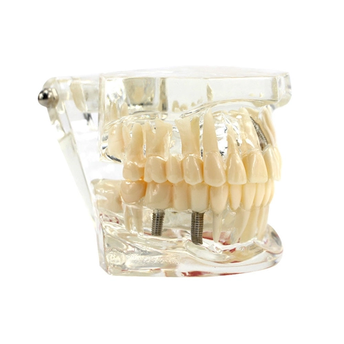 ****Dental Implant Disease Study Teachin Teeth Model With Restoration &amp; Bridge Tooth