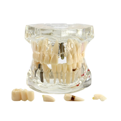 ****Dental Implant Disease Study Teachin Teeth Model With Restoration &amp; Bridge Tooth