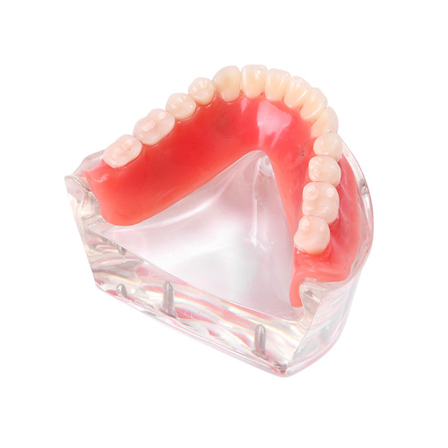 ****Dental Teeth Model Overdenture Inferior 4 Implants Demo Lower Model