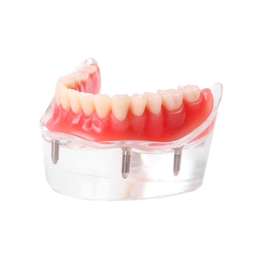 ****Dental Teeth Model Overdenture Inferior 4 Implants Demo Lower Model