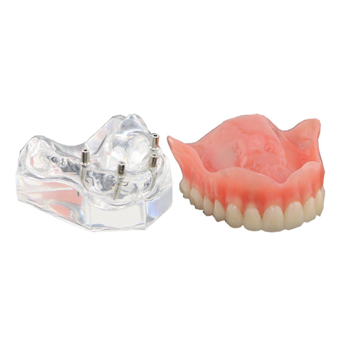 ****Dental Upper Teeth Model Overdenture Superior 4 Implants Demo Model