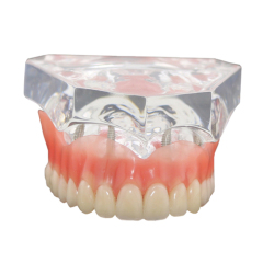 Dental Upper Teeth Model Overdenture Superior 4 Implants Demo Model