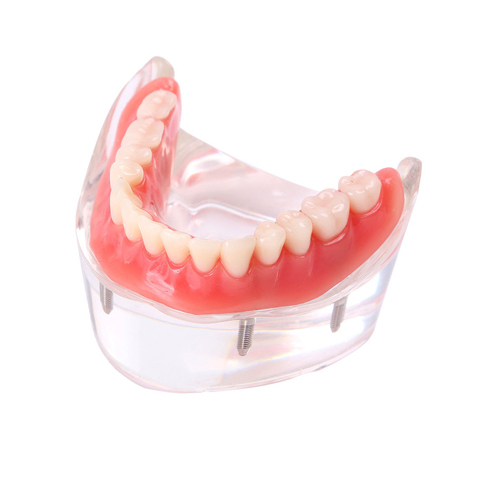 ****Dental Teeth Model Overdenture Inferior 4 Implants Demo Lower Model