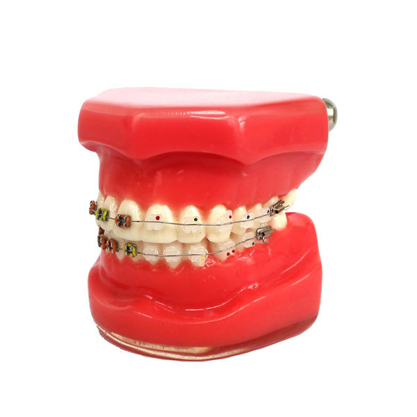 ****Dental Orthodontic Study Teeth Model With Ceramic & Metal Brackets