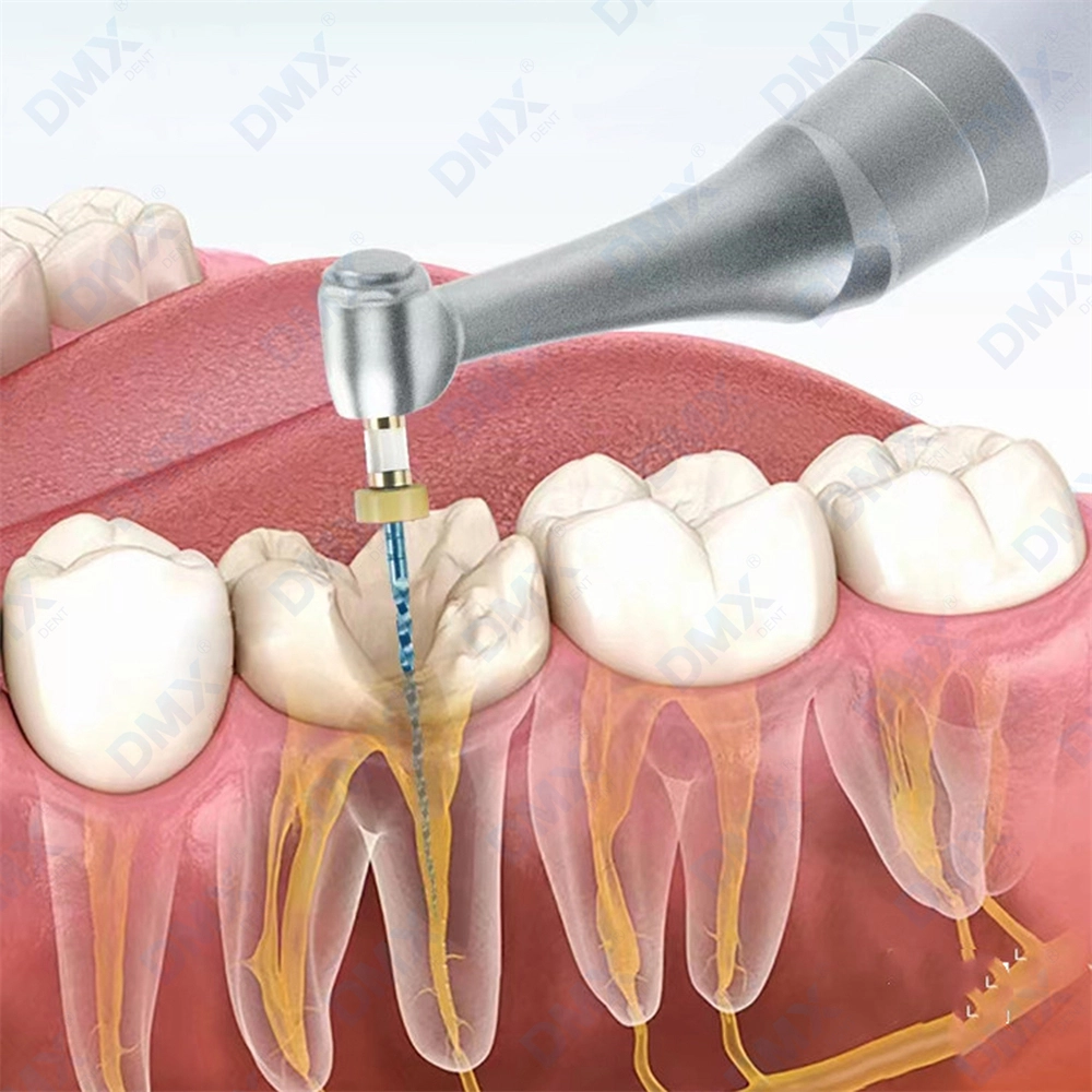 Dental Wireless Endo Motor 16:1 Contra Angle Endodontic Root Canal ...