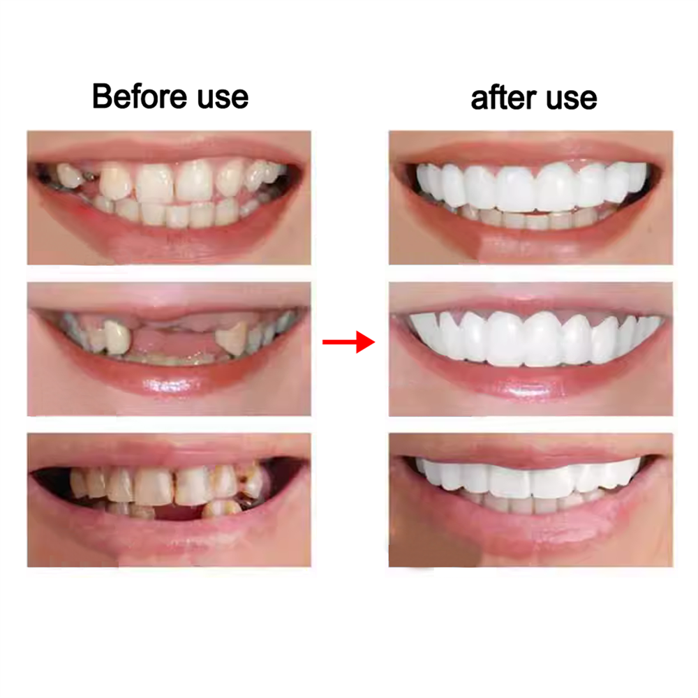Tooth False Teeth Denture Veneers Dental Tooth False Teeth Set