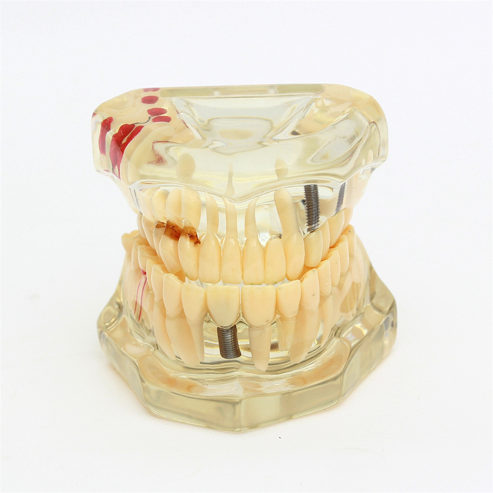 Dental Teeth Model Study Orthodontic Removable Teeth Implant Teaching Model