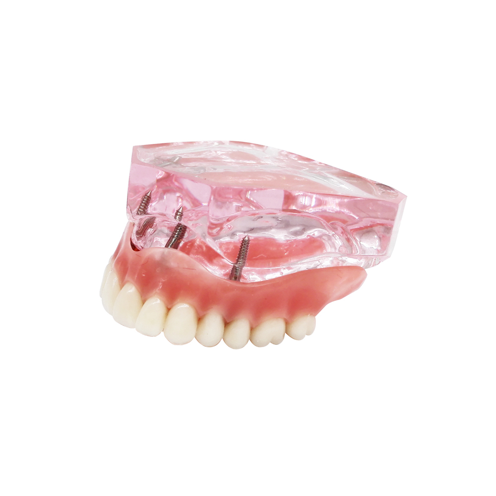 Dental Teeth Model Study Orthodontic Removable Teeth Implant Teaching Model