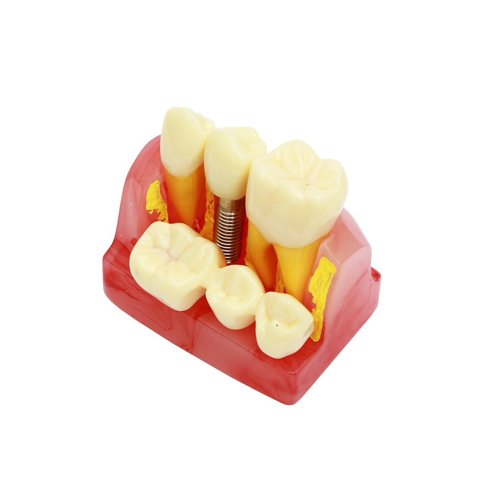 Dental Teeth Model Study Orthodontic Removable Teeth Implant Teaching Model