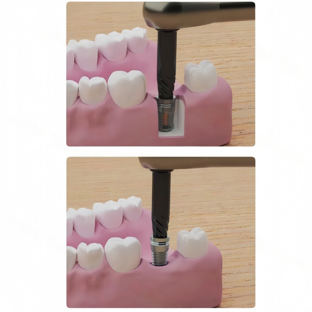 Dental Fixture Remover Screw | SOS Retrieval Screw for Broken Implants & Failed Implant Fixture Removal