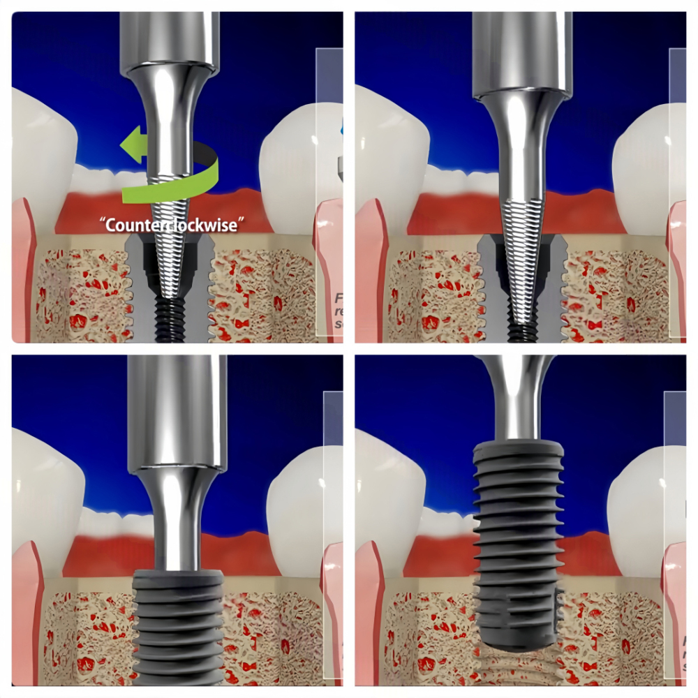 Dental Fixture Remover Screw | SOS Retrieval Screw for Broken Implants & Failed Implant Fixture Removal
