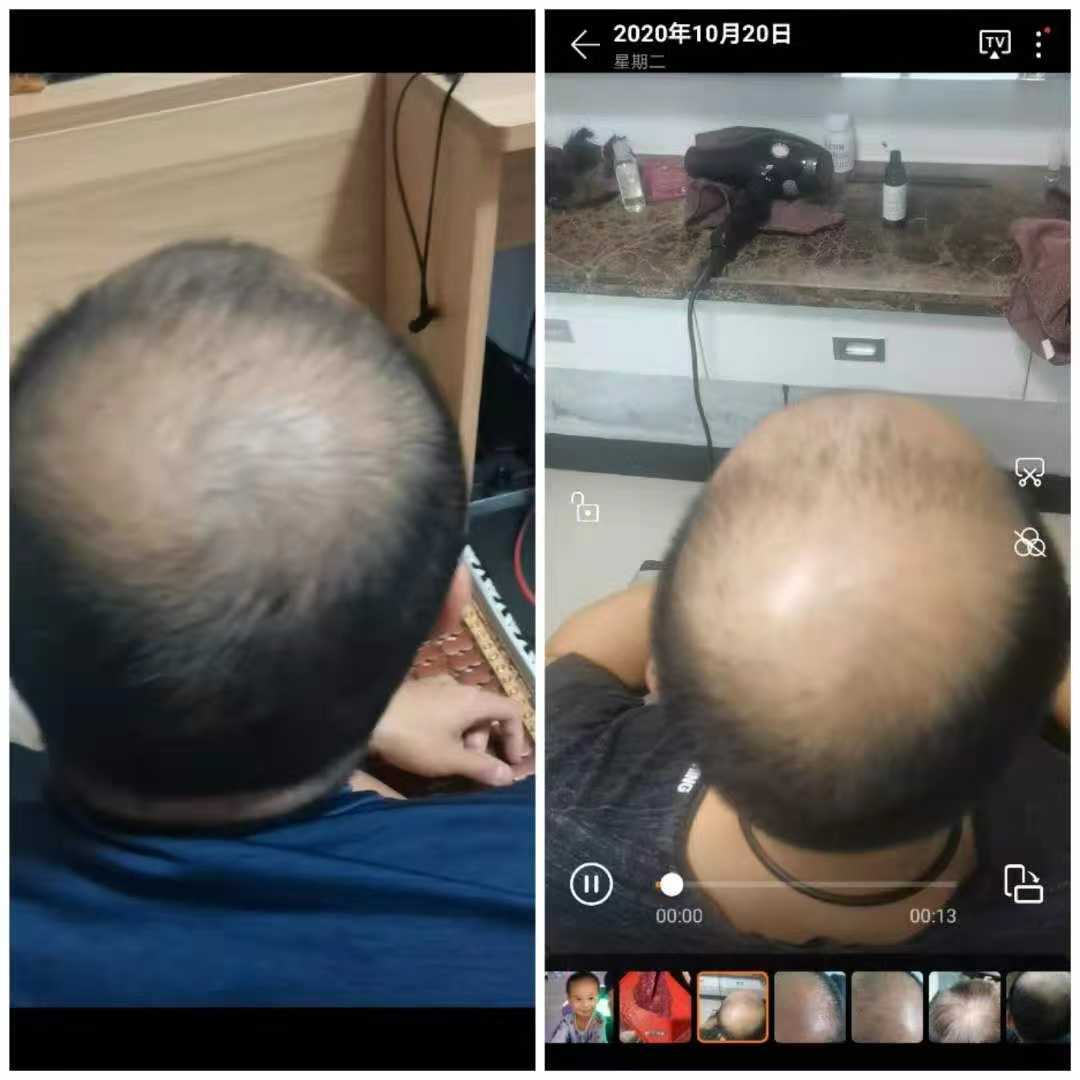 Traditional Chinese medicine hair regrowth spray