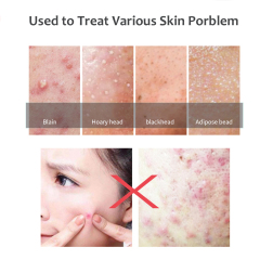 Acne Remover Tool Kit