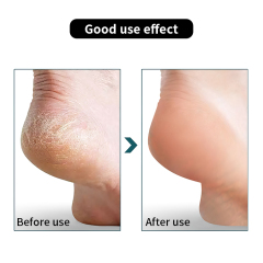 Stainless Steel Foot File Callus Remover Professional Foot Scrubber Pedicure Tool