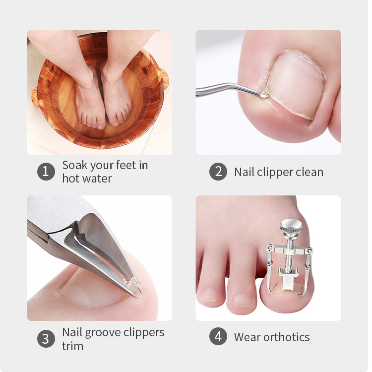 Toe Nail Nippers for Ingrown And Thick Toenails Sharp Curved Blade Clippers