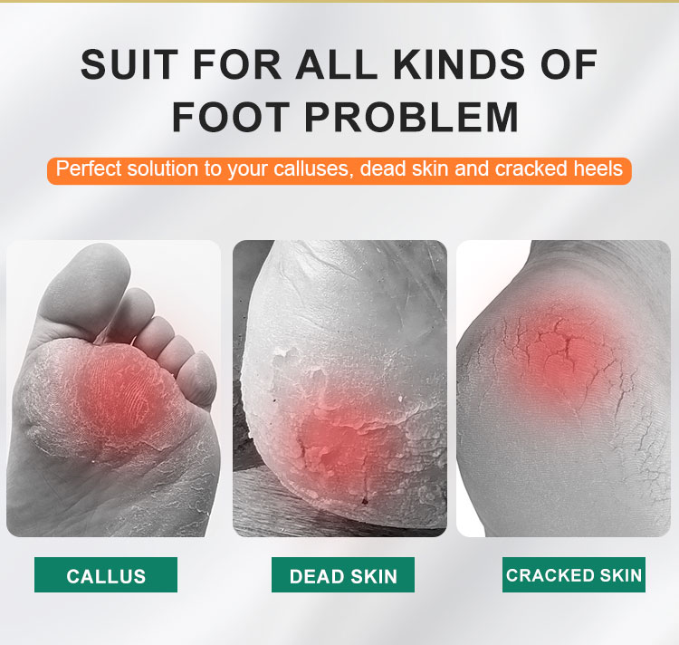 callus remover