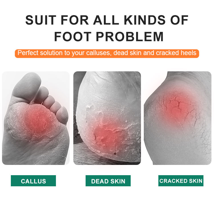 feet dead skin remover