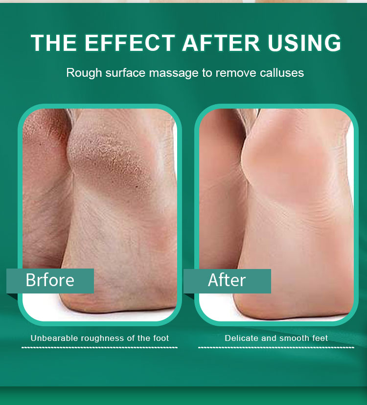 Callus Remover