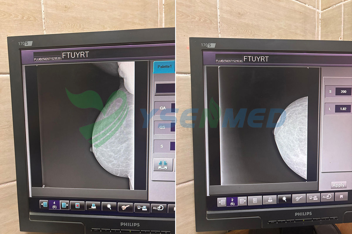 YSFPD-R1012C mammo flat panel detector works well in a Togo hospital.