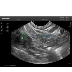 Ecoendoscopio de matriz lineal Sonoscape EG-UC5T