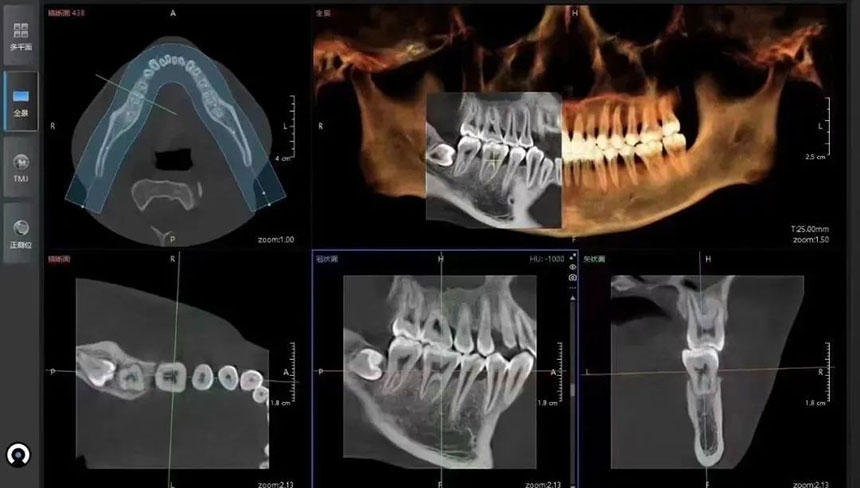 The development history of oral CBCT