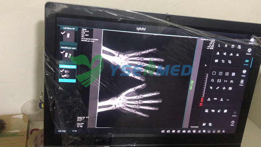 Philippinese customer upgraded his analog x-ray system with YSFPD-M1717V DR panel.