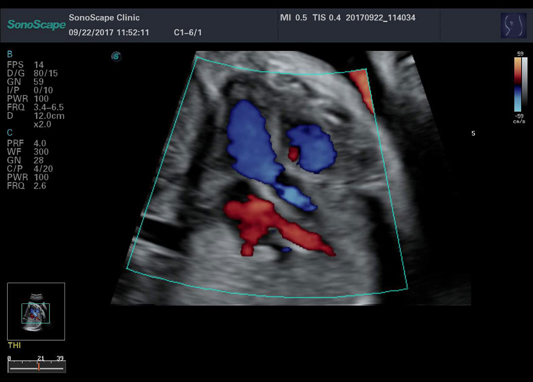 Sonoscape P50 4D Trolley Color Doppler Ultrasound Machine