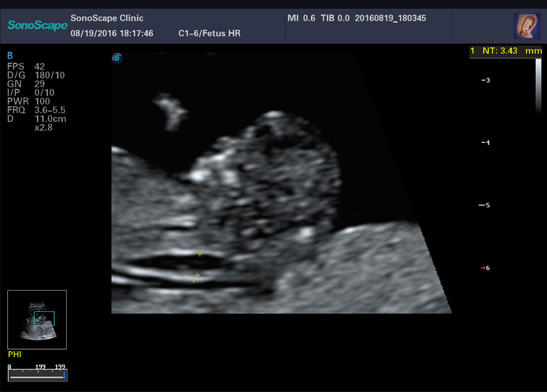 Color Doppler Trolley Ultrasound Scanner Sonoscape P20